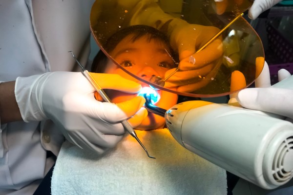 Tooth Colored Dental Bonding Procedure For Teeth Repair