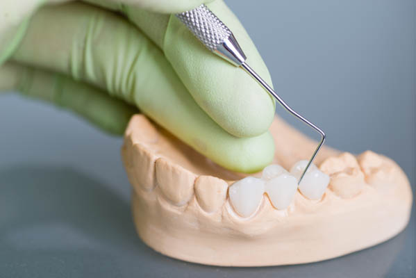 Who Makes A Good Candidate For Dental Bridges?