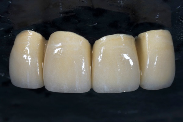 Benefits Of Dental Bridges