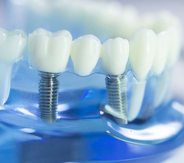 San Dimas Dental Implants