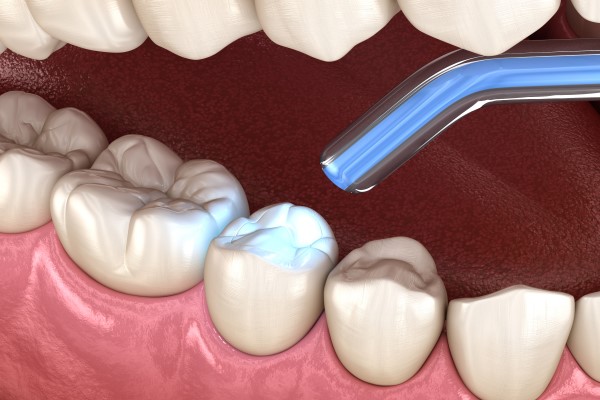 When Are Dentals Fillings Used As A Dental Restoration?
