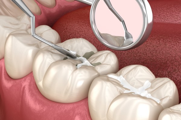 What Materials Are Used To Make Dental Sealants?
