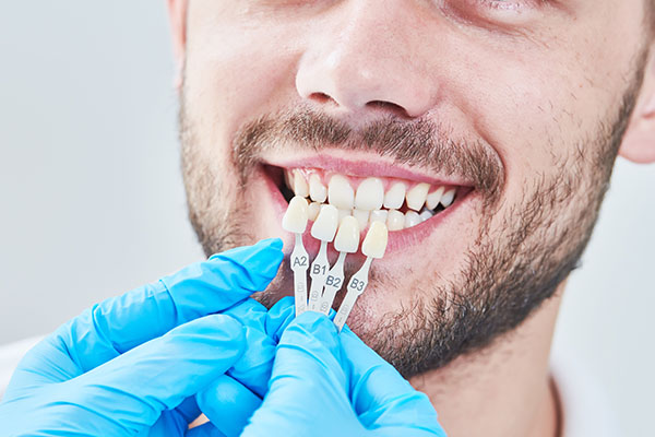 How Are Veneers Replaced?