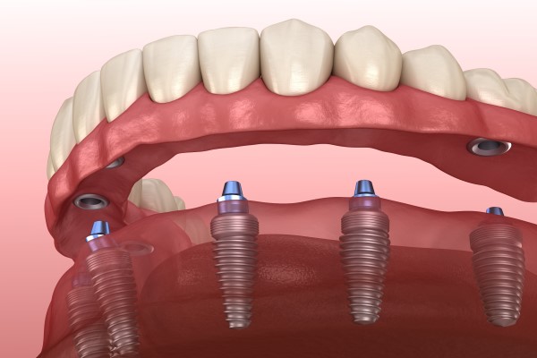 Why Choose Implant Supported Dentures Over Traditional Dentures