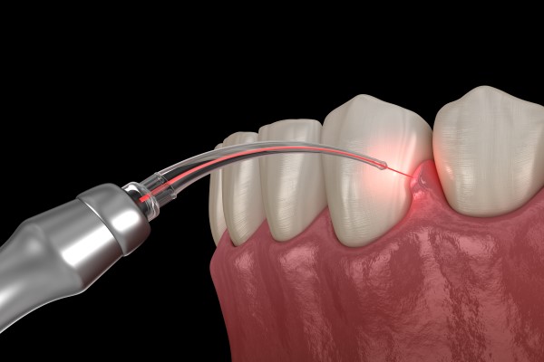 How Gum Disease Can Be Treated With Laser Dentistry
