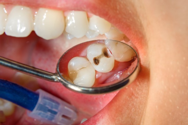 How Can I Tell If I Have A Cavity?