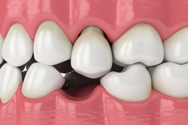 How a General Dentist Can Repair a Damaged Tooth