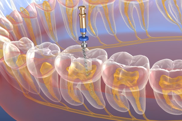 Why A Root Canal Treatment May Be Your Best Option