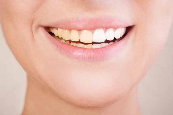 Age That You Can Start Having Professional Teeth Whitening?